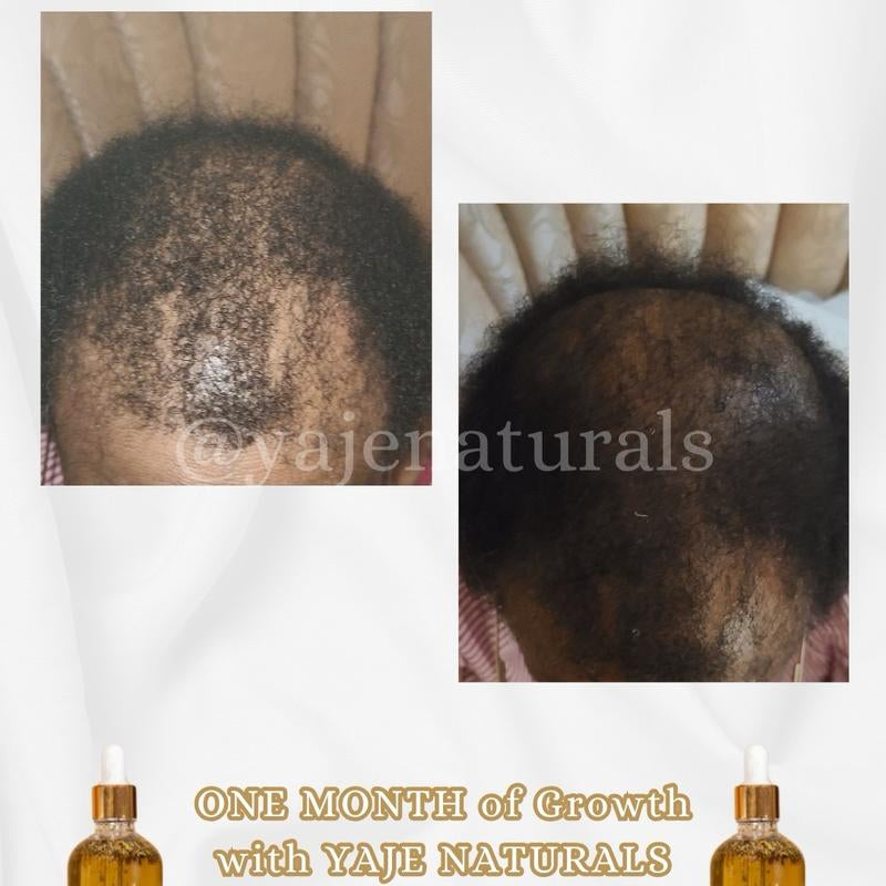 Double Growth – All-Natural Super Potent Hair Growth Oil | 13+ Herbs & 10 Oils | Fast Hair Regrowth & Bald Spot Treatment